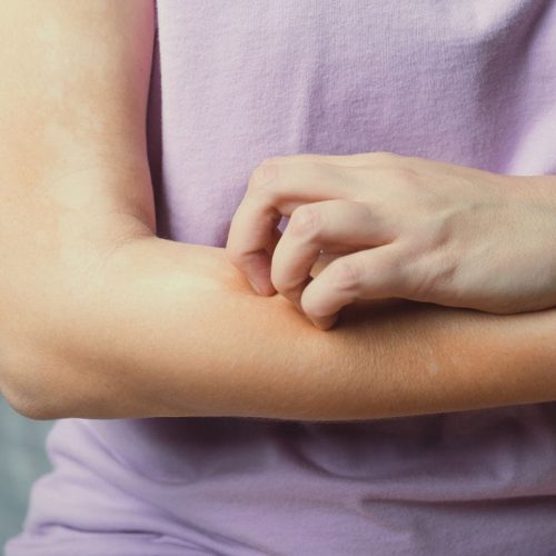 Juckreiz bei Neurodermitis. Hand kratzt gereizte Haut am Unterarm.